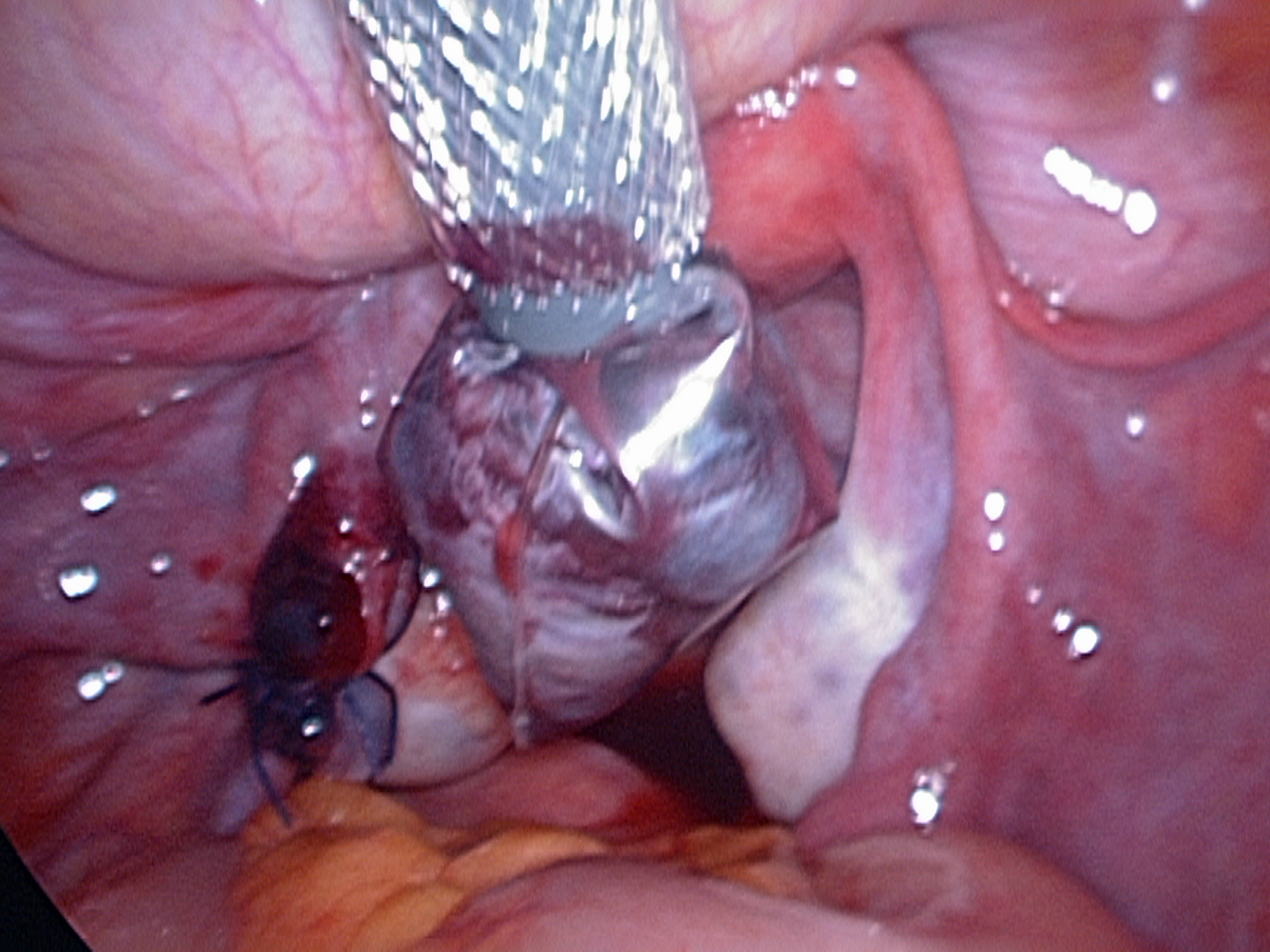 Endopouch-twisted-fallopian tube-prior-to-removal Endopouch-twisted-fallopian tube-prior-to-removal