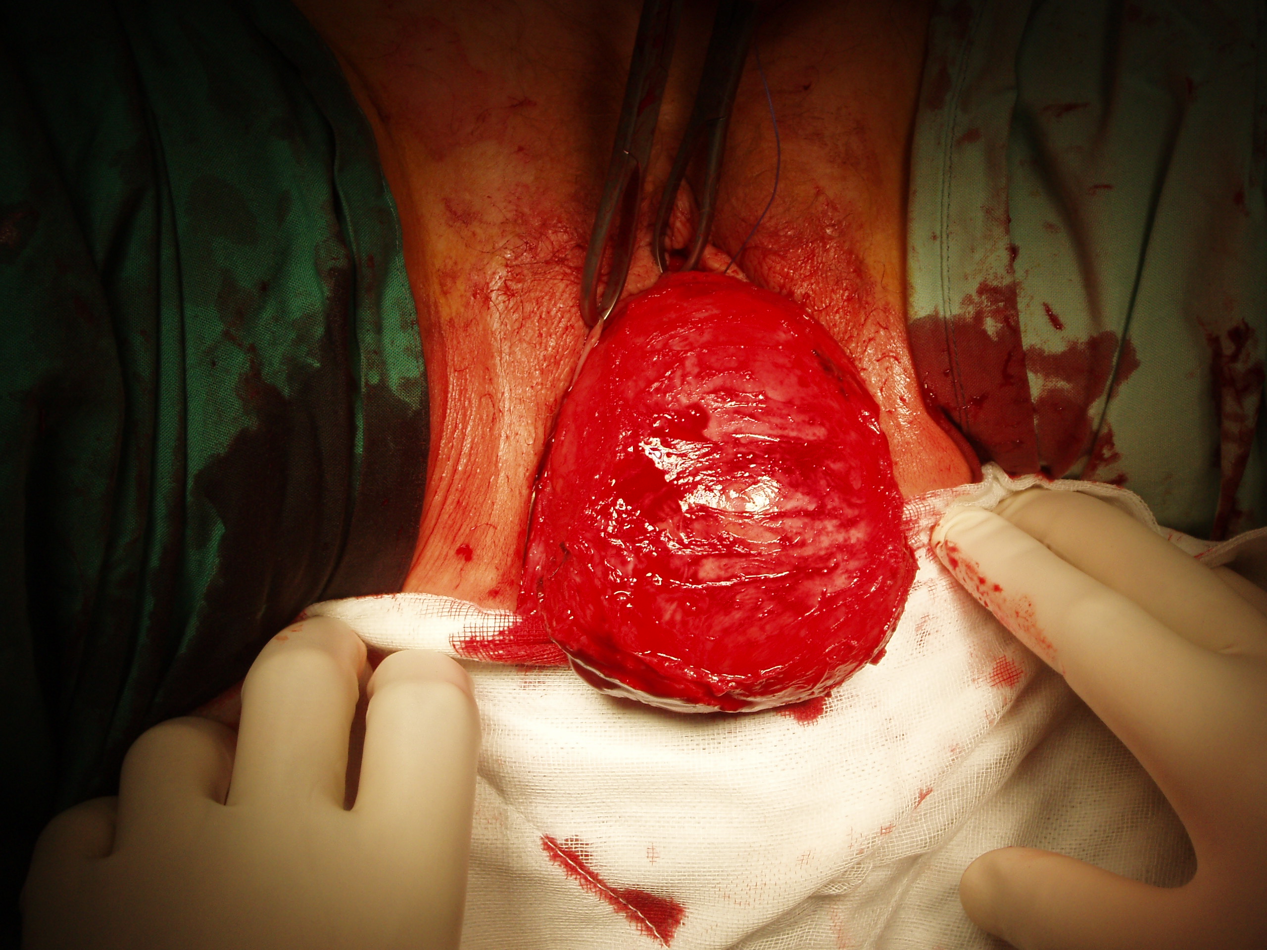 repair of cystocele perigee mesh repair of cystocele perigee mesh