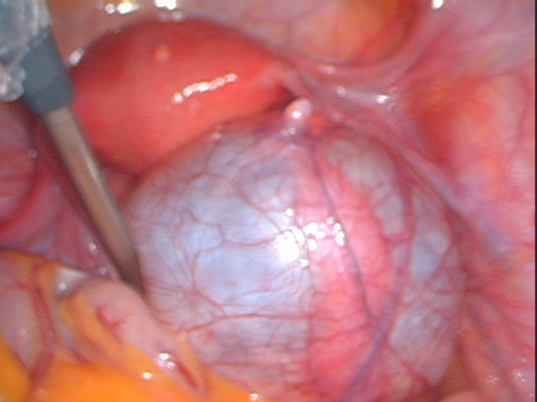 tube stretched on ovarian cyst
