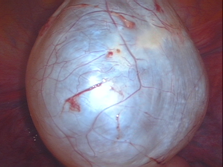 cyst after separation from ovary