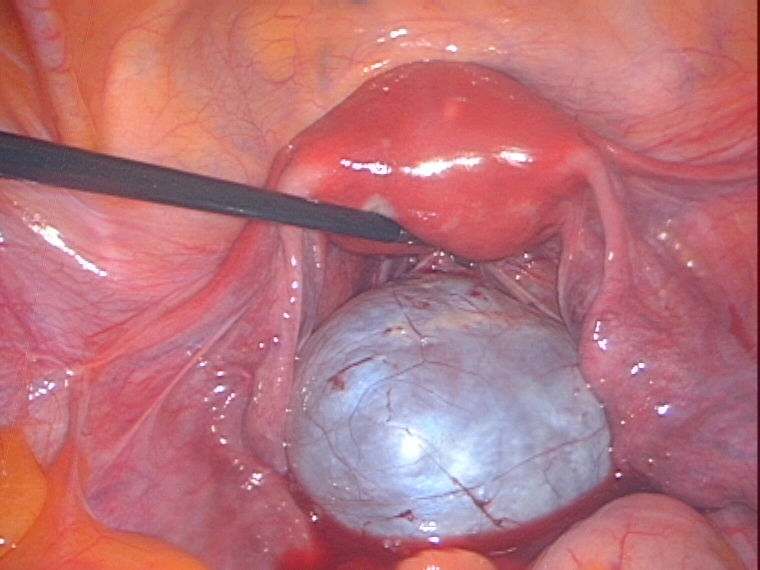 8 cm ovarian cyst