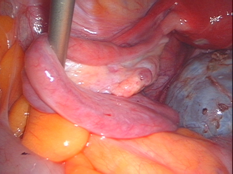 normal shaped tube after cyst removal normal shaped tube after cyst removal