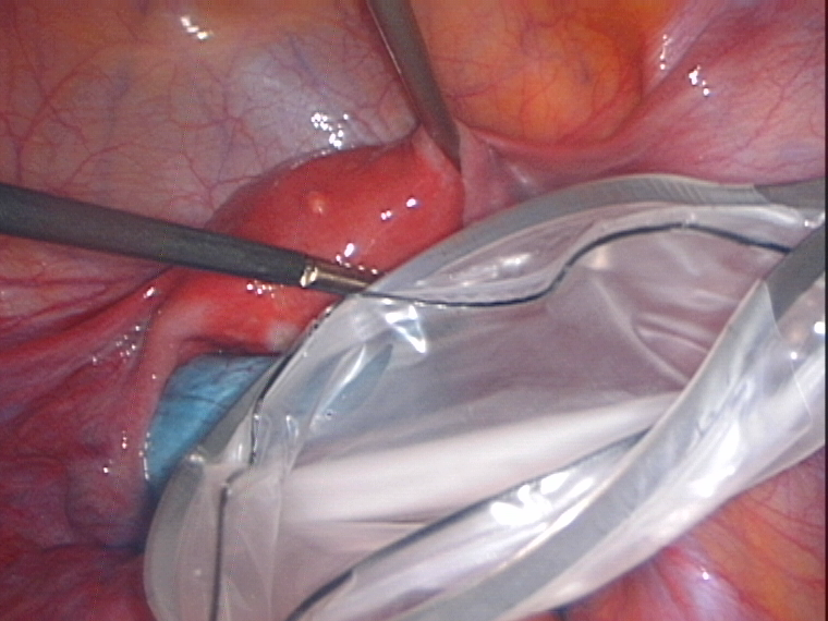Endopouch to place cyst in it
