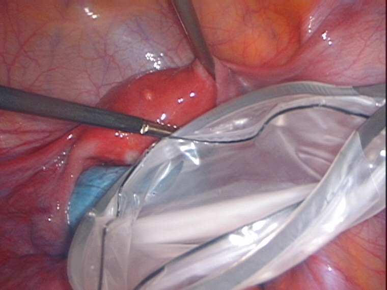 Endopouch to place cyst in it Endopouch to place cyst in it