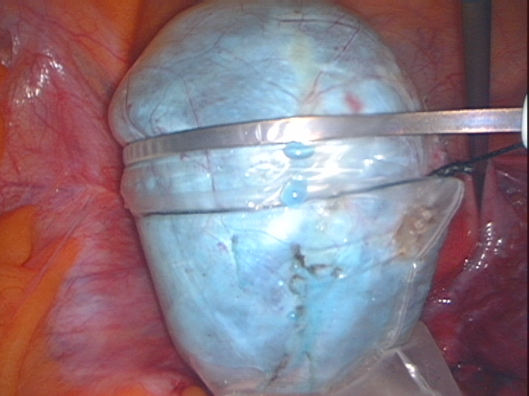 ovarian cyst in endopouch youssif ovarian cyst in endopouch youssif