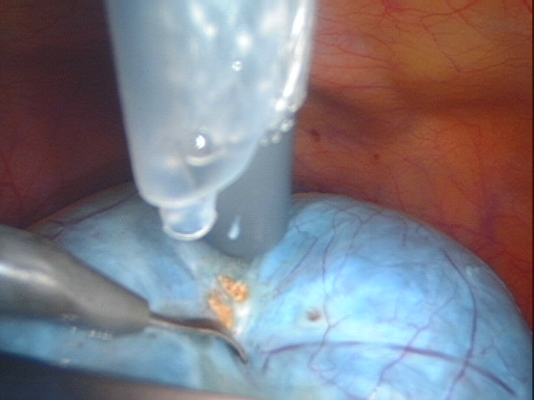 sucking fluid from cyst in the bag sucking fluid from cyst in the bag