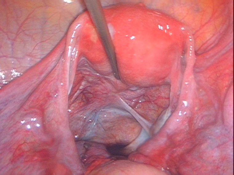 uterus tubes after removal of ovarian cyst