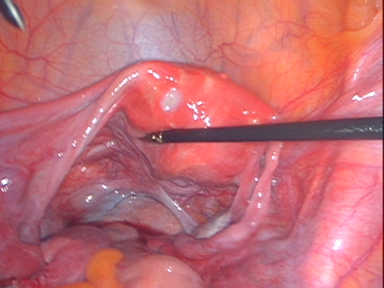 normal pelvis after cyst removal normal pelvis after cyst removal