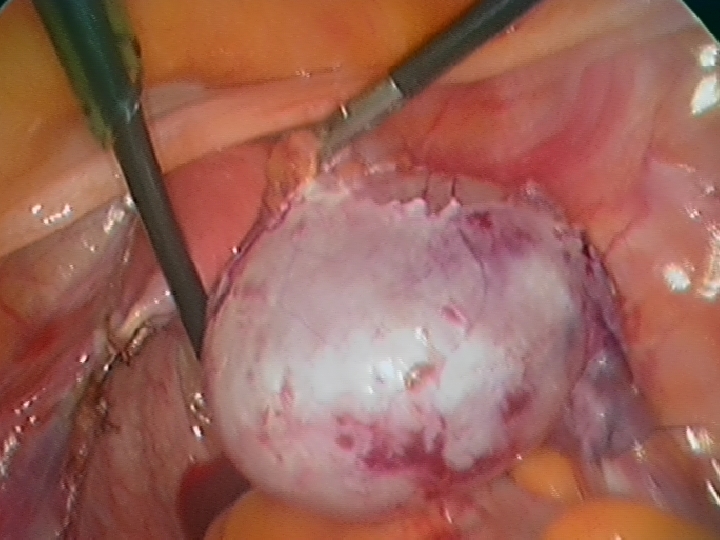 Cyst and Ovary fully Separated