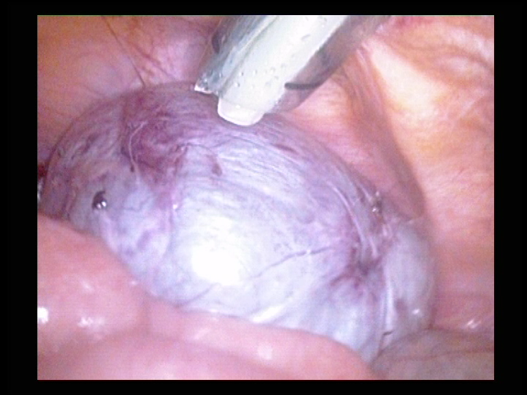 Cyst removed in Pouch of Douglas Serag Youssif