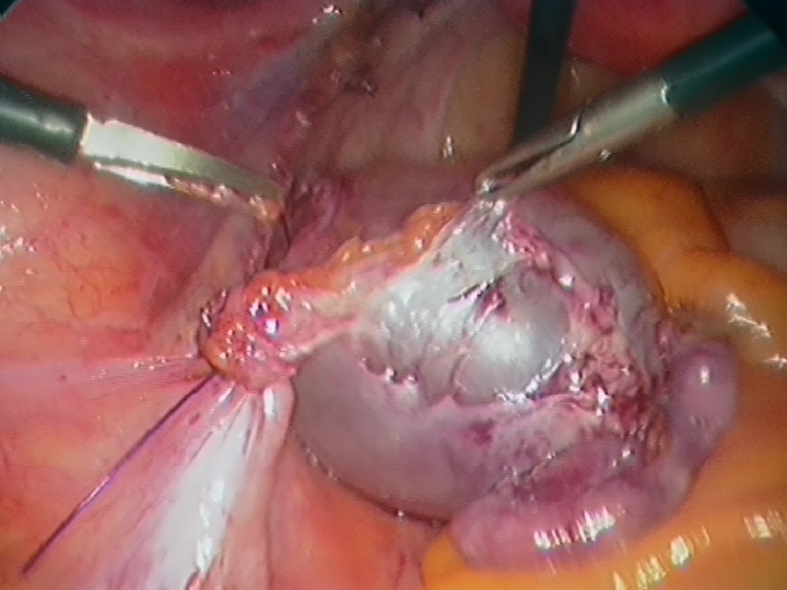 Dividing the Pedicle and Removing the Cyst and Ovary and Tube