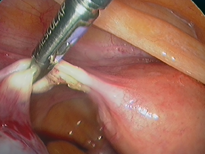 Division of Left  Tubo-Ovarian Ligament