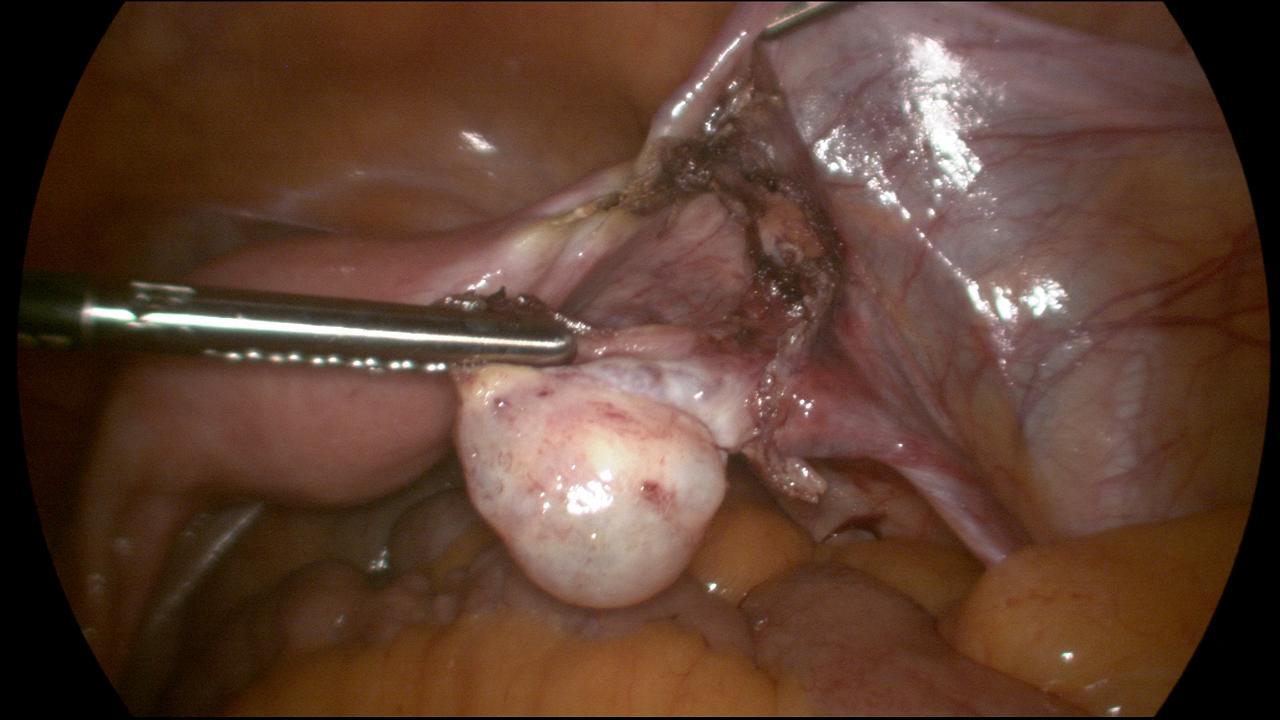 Division of Right Fallopian Tubes and Tubo Ovarian Ligament