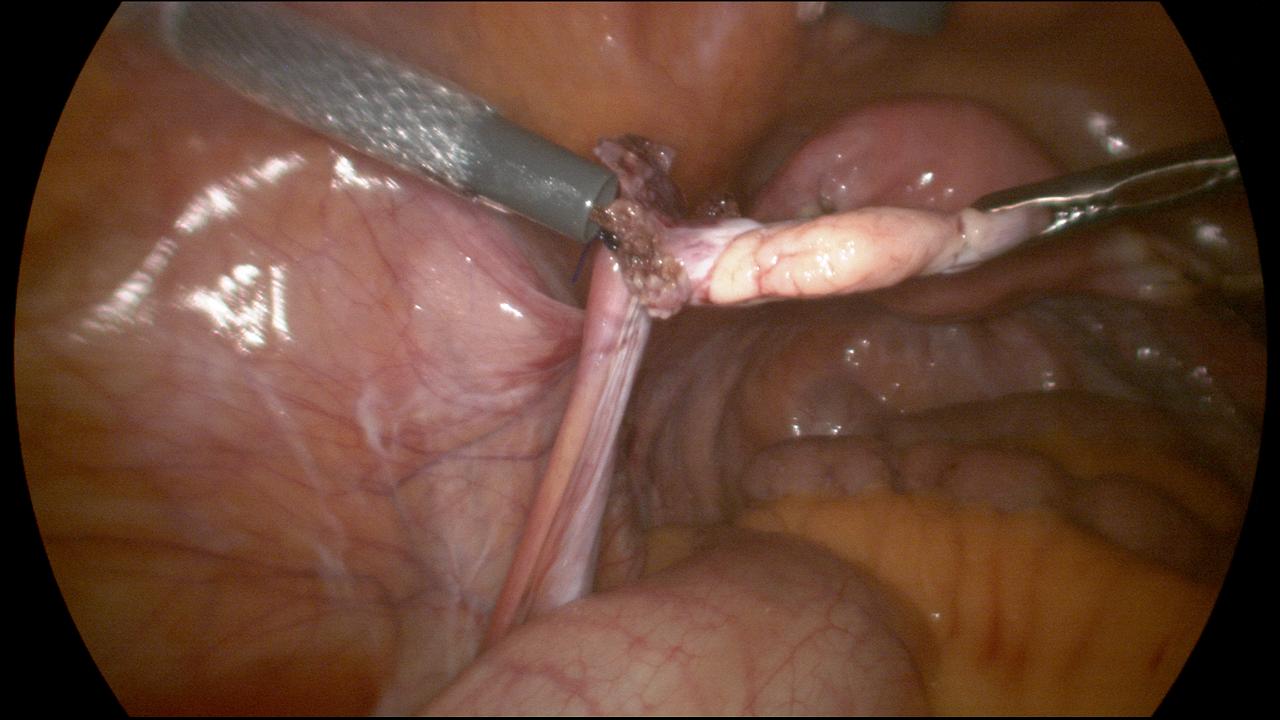 Endoloop around Left Ovarian Pedicle