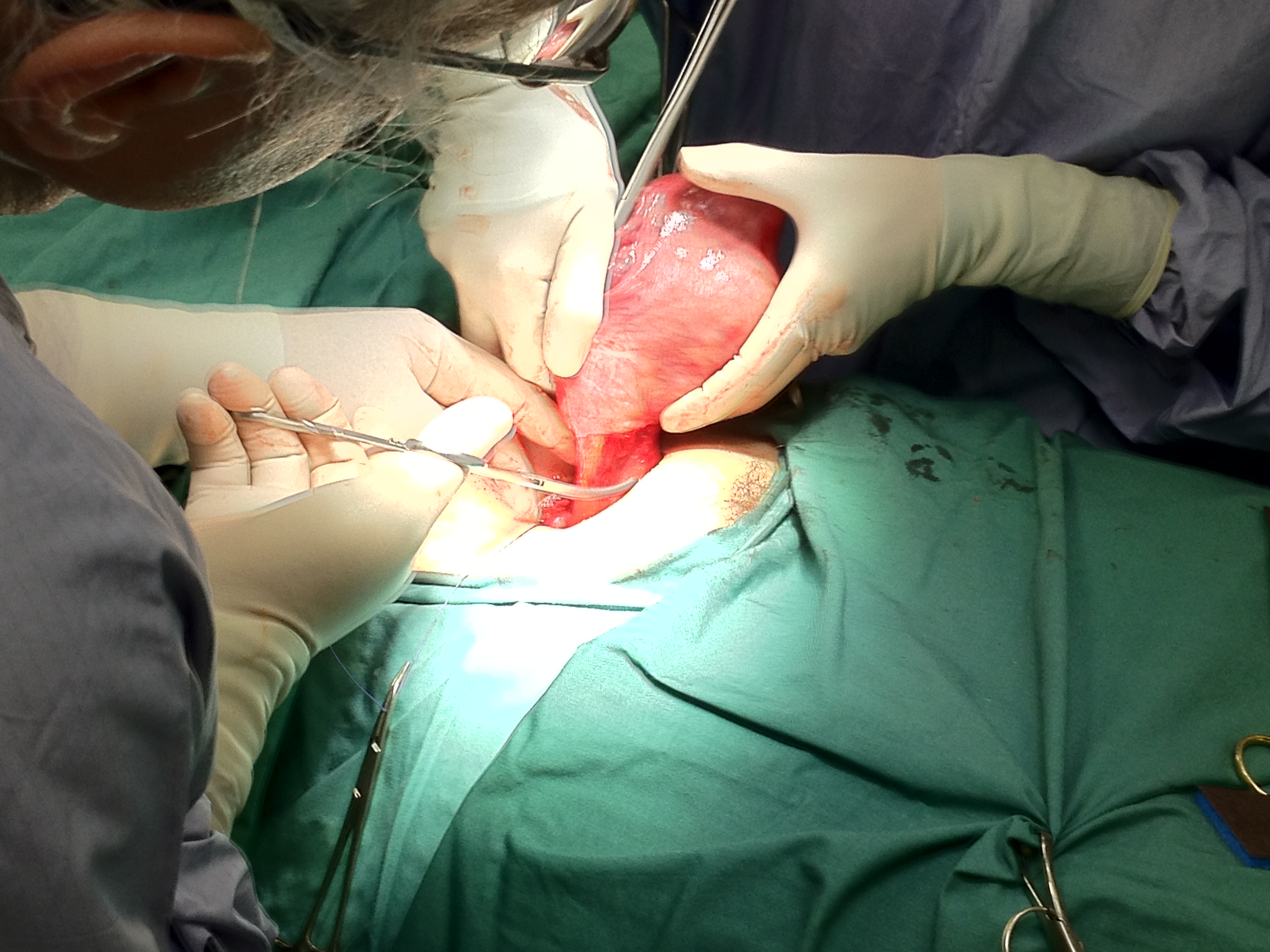 Fibroids Hysterectomy Dr Serag Youssif 5