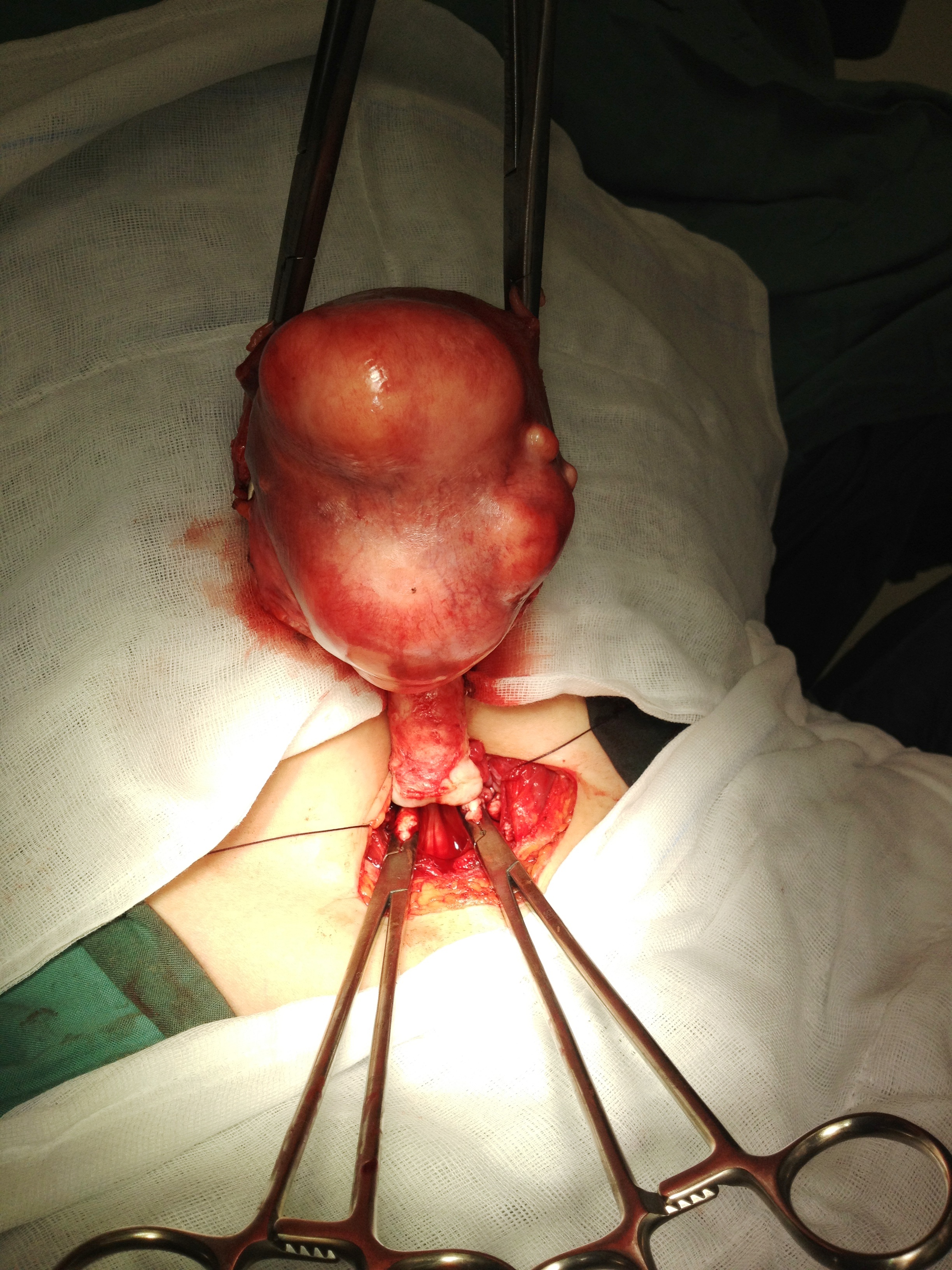 Fibroids Hysterectomy Dr Serag Youssif 7