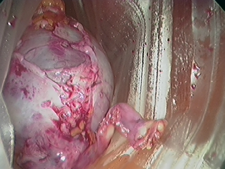 Left Ovarian Cyst and Ovary in Endo-Bag Prior to Removal