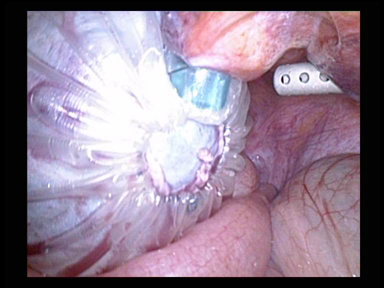Ovarian Cyst In a Bag Prior to Removal Serag Youssif
