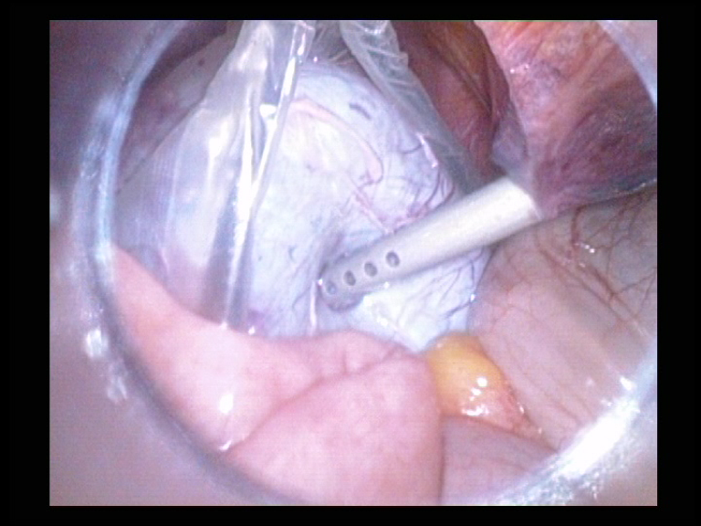 Ovarian Cyst Placed in Endo Bag Serag Youssif