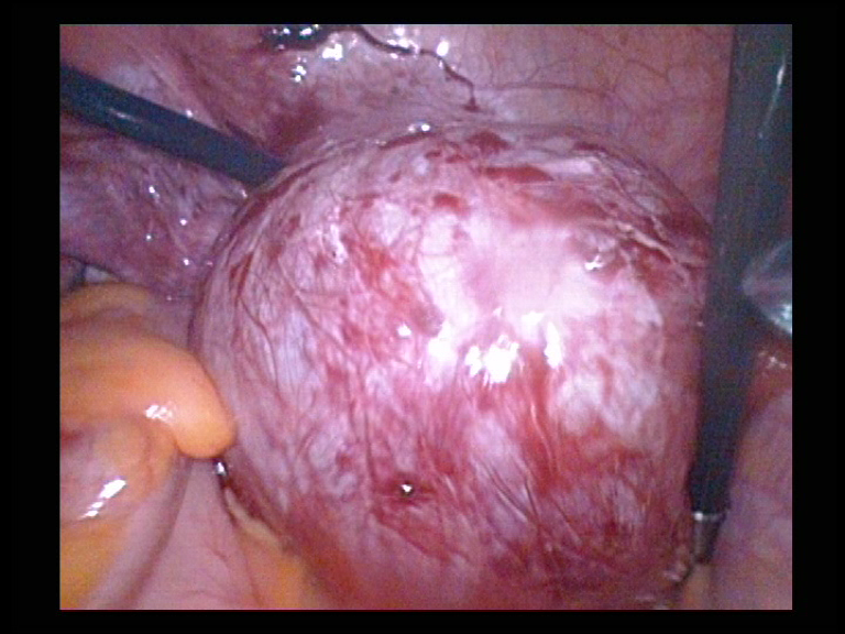 Right Ovarian Cyst Removal  Shelling out the Cyst  6 Serag Youssif