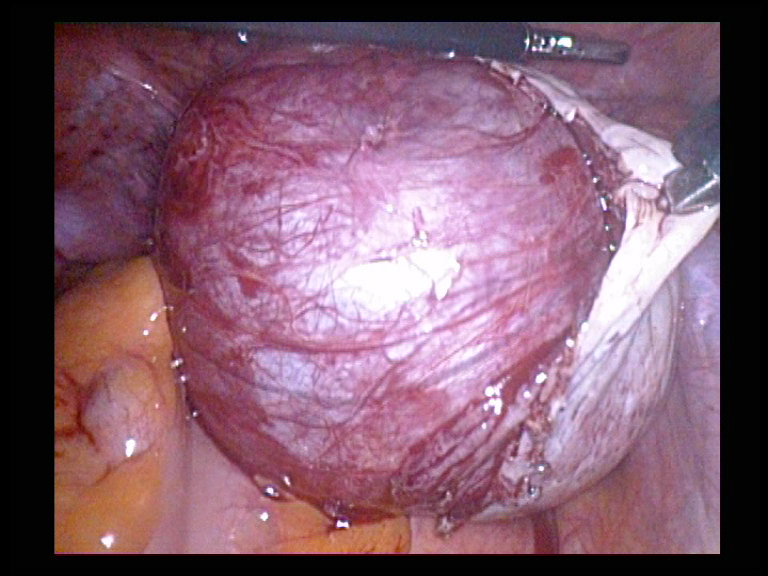 Right Ovarian Cyst Removal  Shelling out the Cyst 7 Serag Youssif