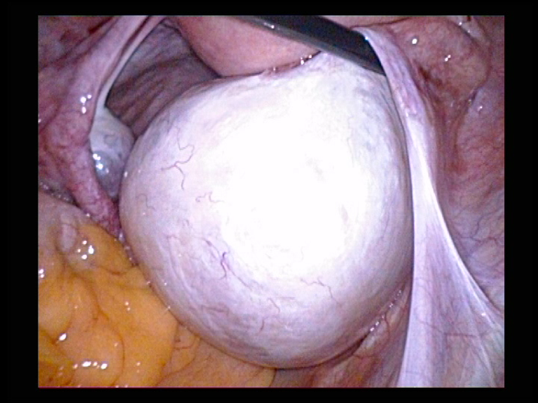 Right Ovarian Cyst Removal 1 Serag Youssif