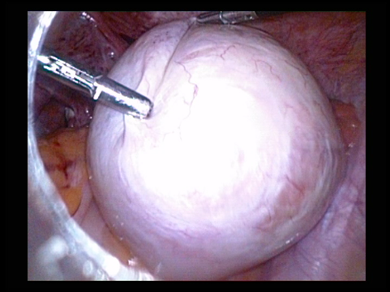 Right Ovarian Cyst Removal 3 Serag Youssif