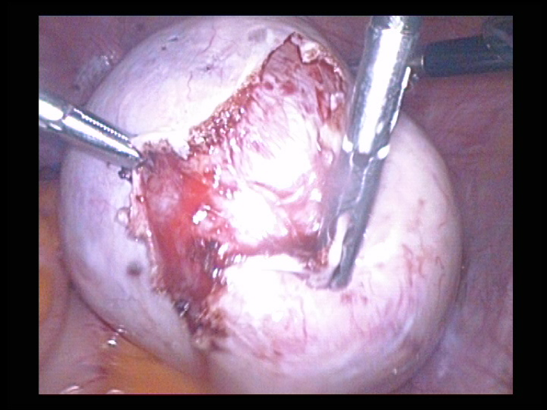Right Ovarian Cyst Removal 5 Serag Youssif
