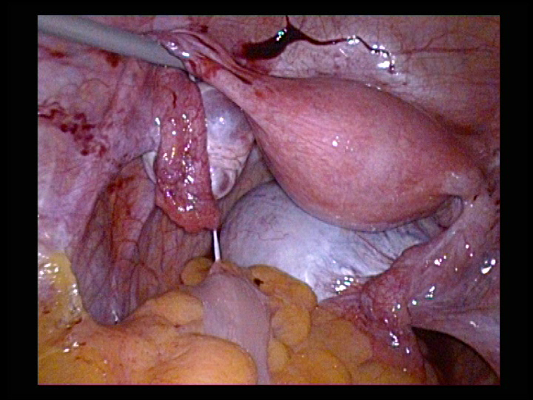 Right Ovarian Cyst Removal PoD Serag Youssif