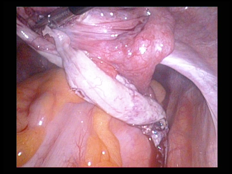 Right Ovarian Cyst Removal.  The Ovary Reconstructed. Serag Youssif