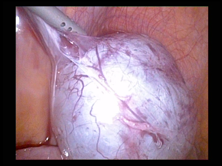 Right Ovarian Cyst Removal. Cyst Nearly Separated Serag Youssif