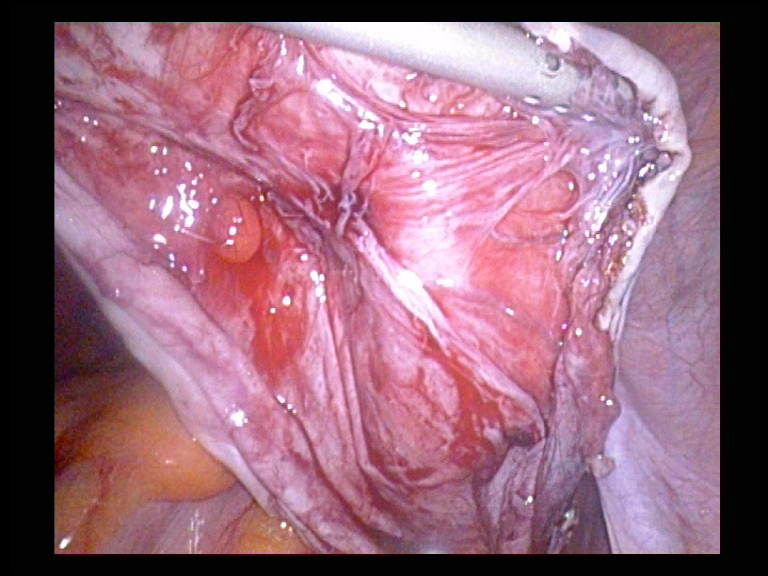 Right Ovary after Cyst was removed. Serag Youssif