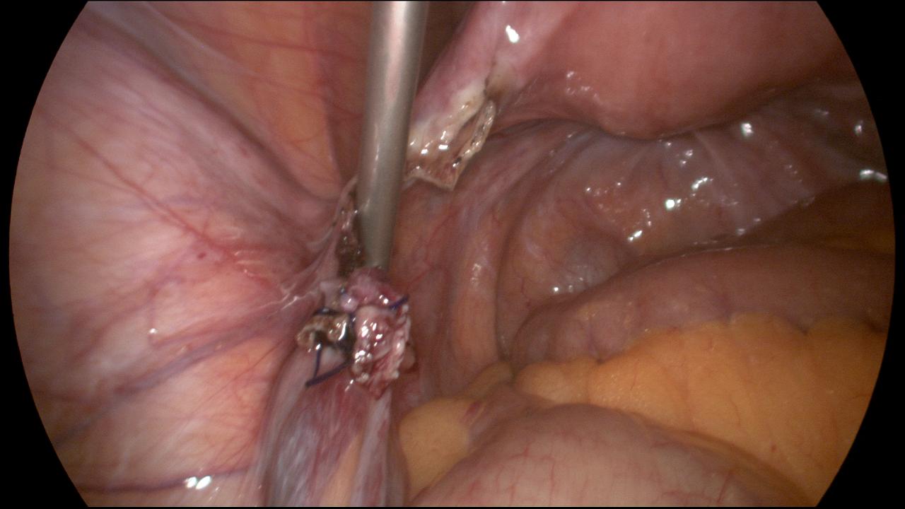 Second Endo-Loop around Left Ovarian Pedicle