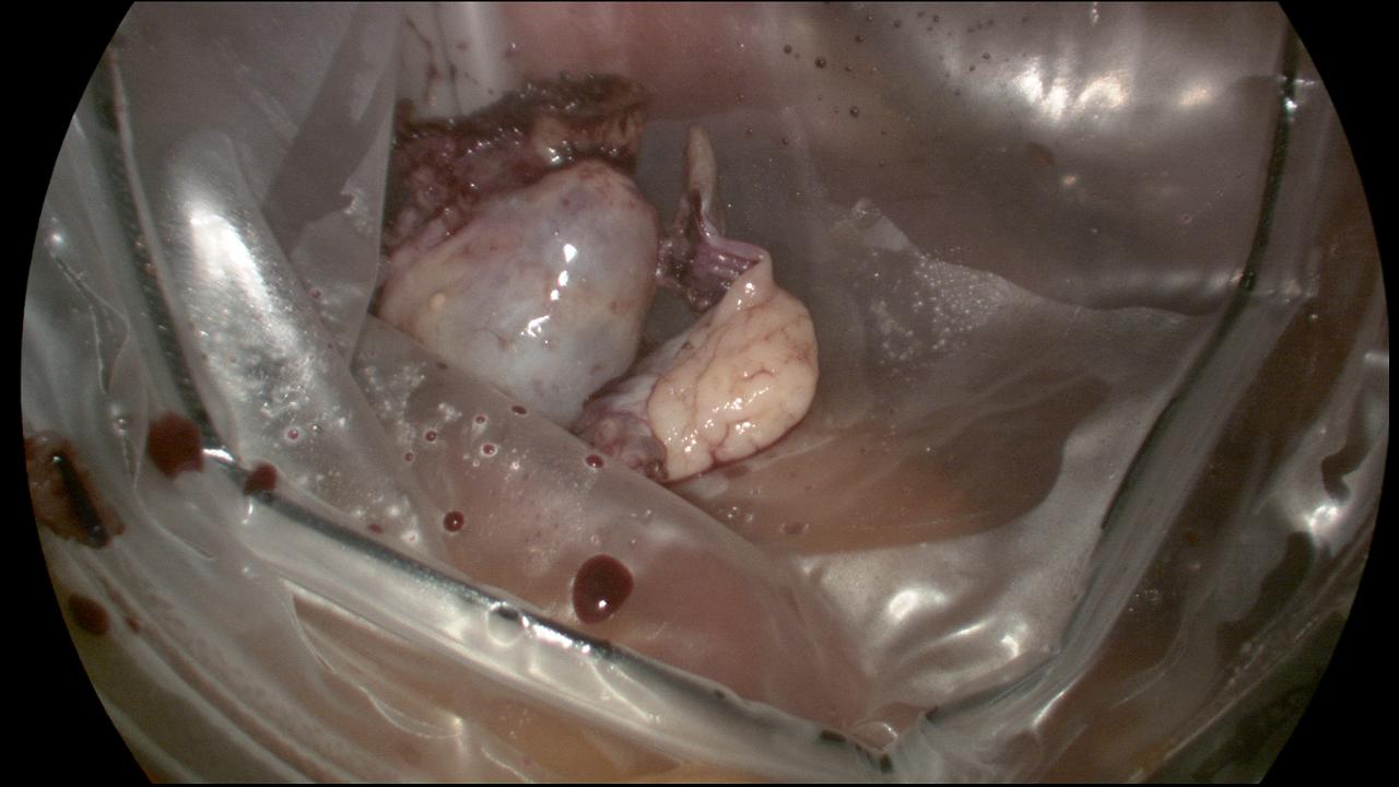Two Ovaries in EndoPouch prior to removal