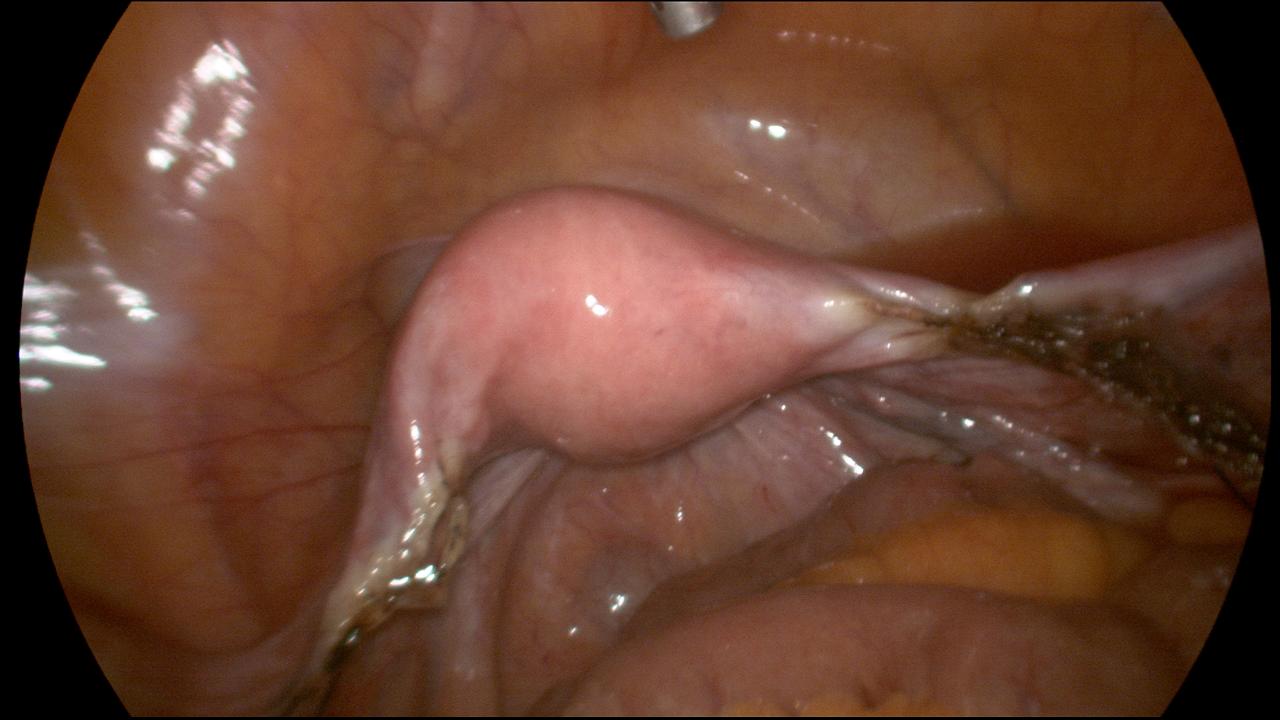 Uterus in Place after removing Both Ovaries