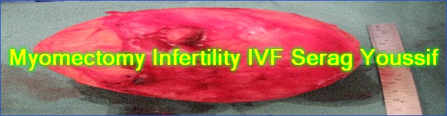 Myomectomy Infertility IVF Serag Youssif