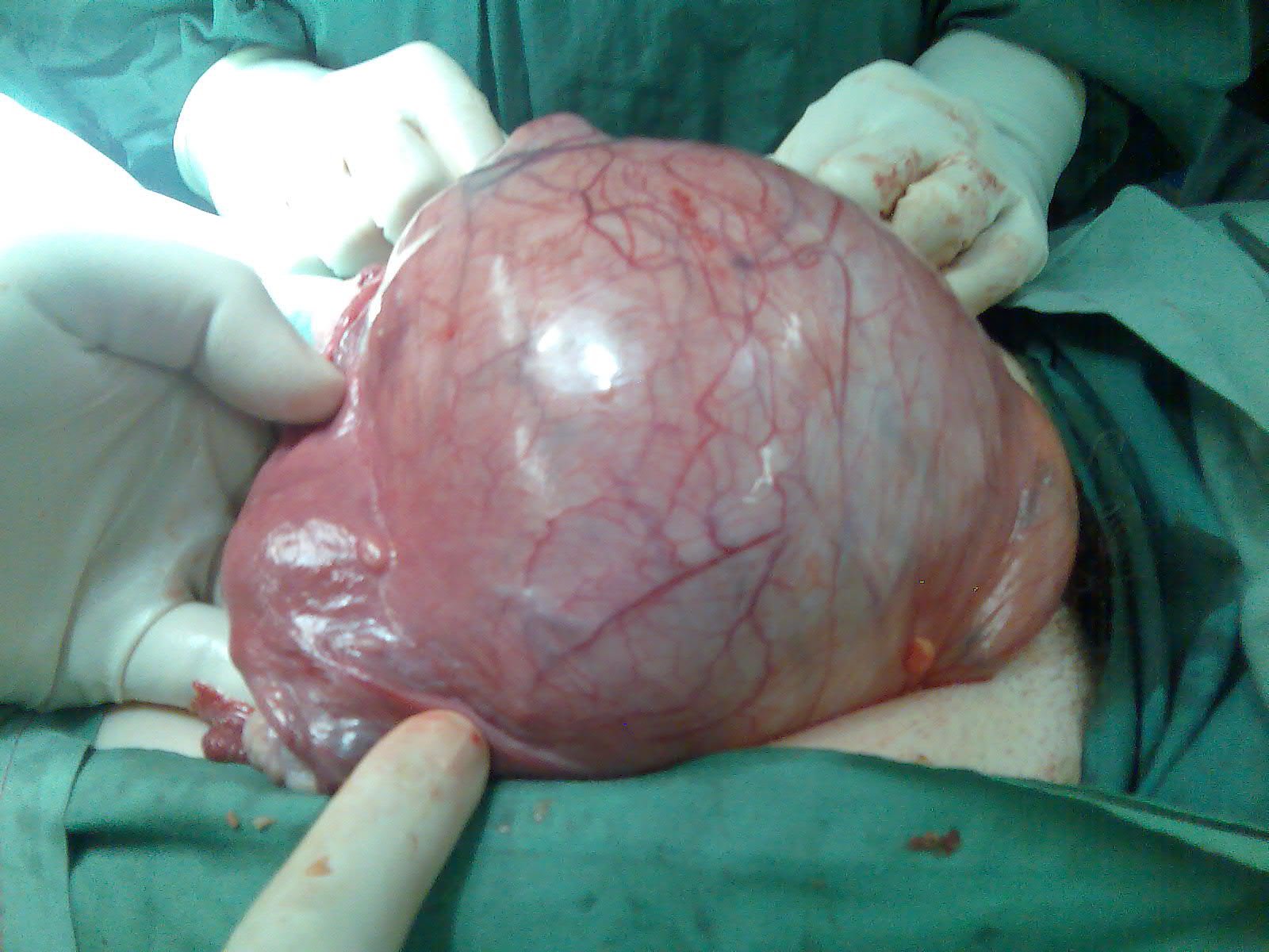 cervical fibroid myoma 30 cm serag youssif