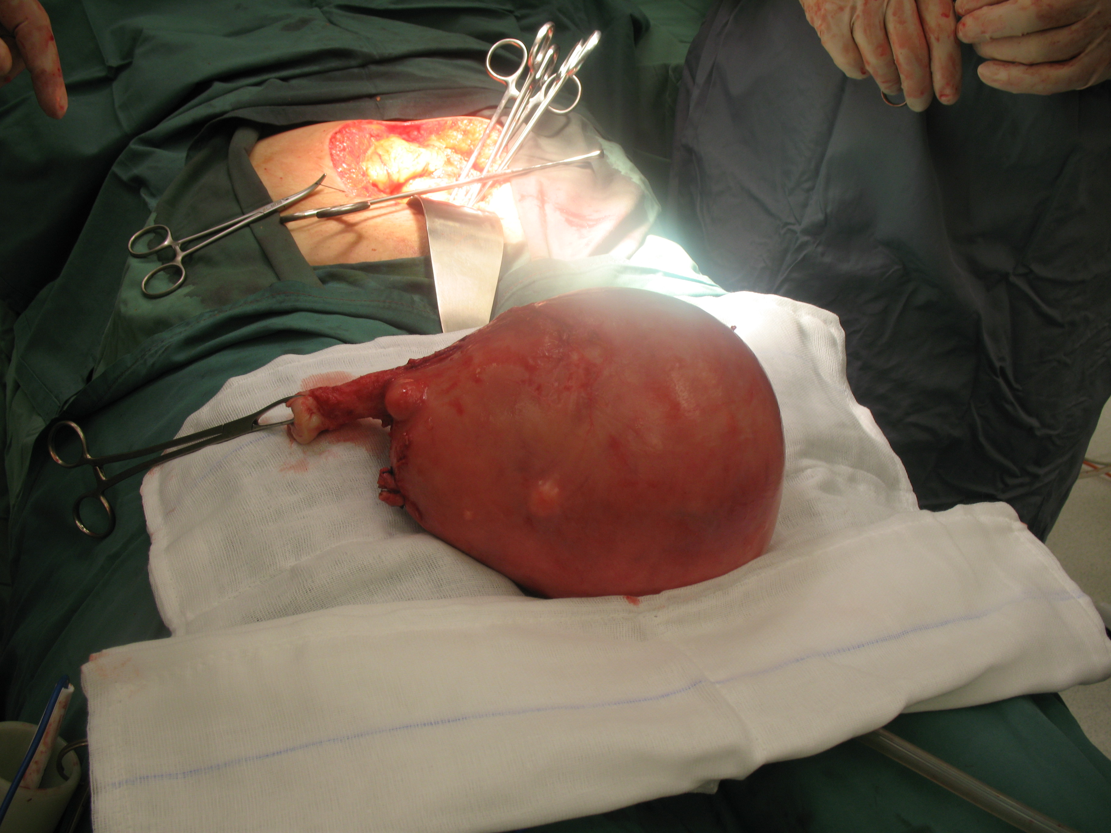 fibroid uterus hysterectomy laparotomy serag youssif