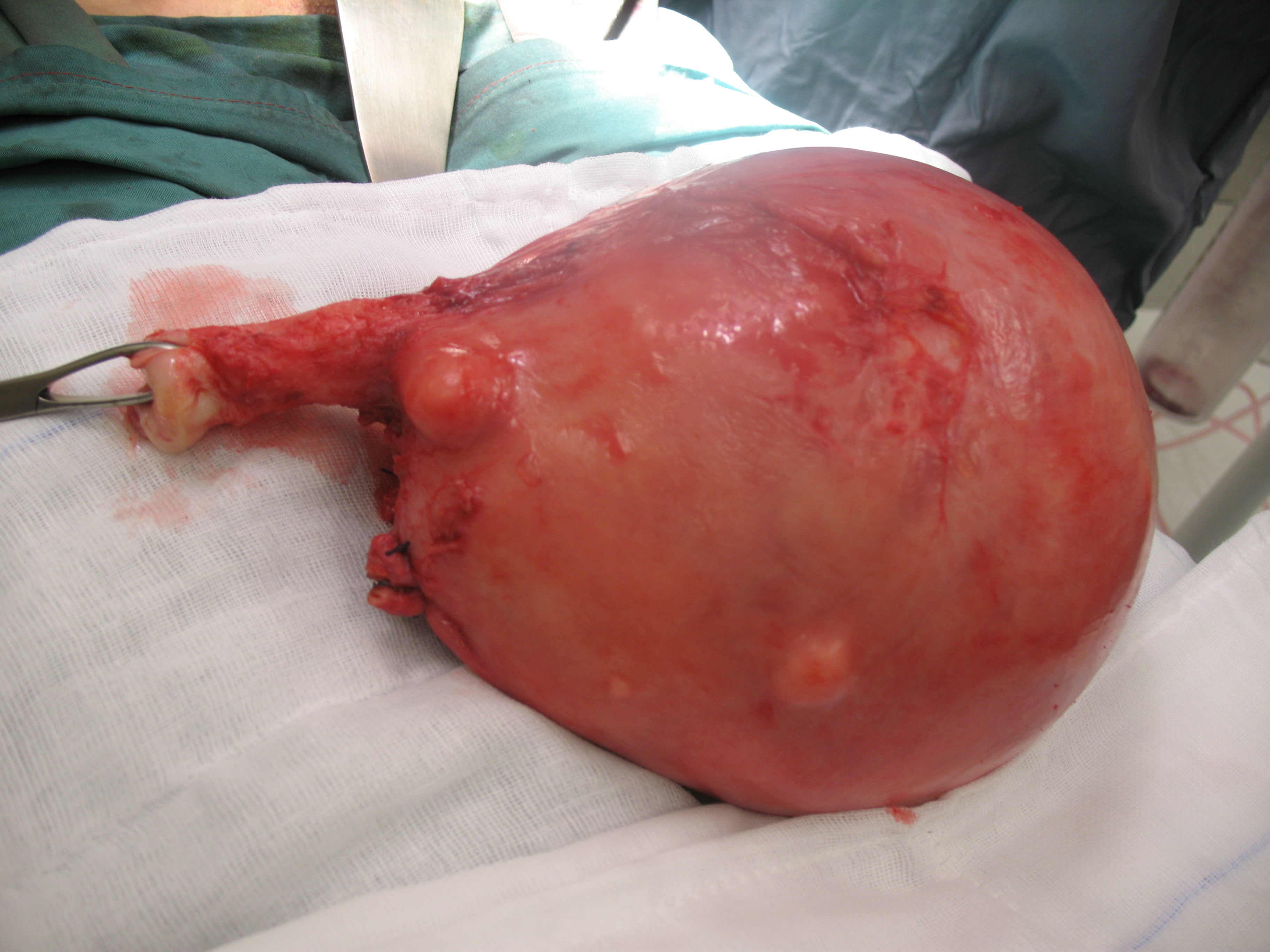 fibroid uterus laparotomy hysterectomy serag youssif