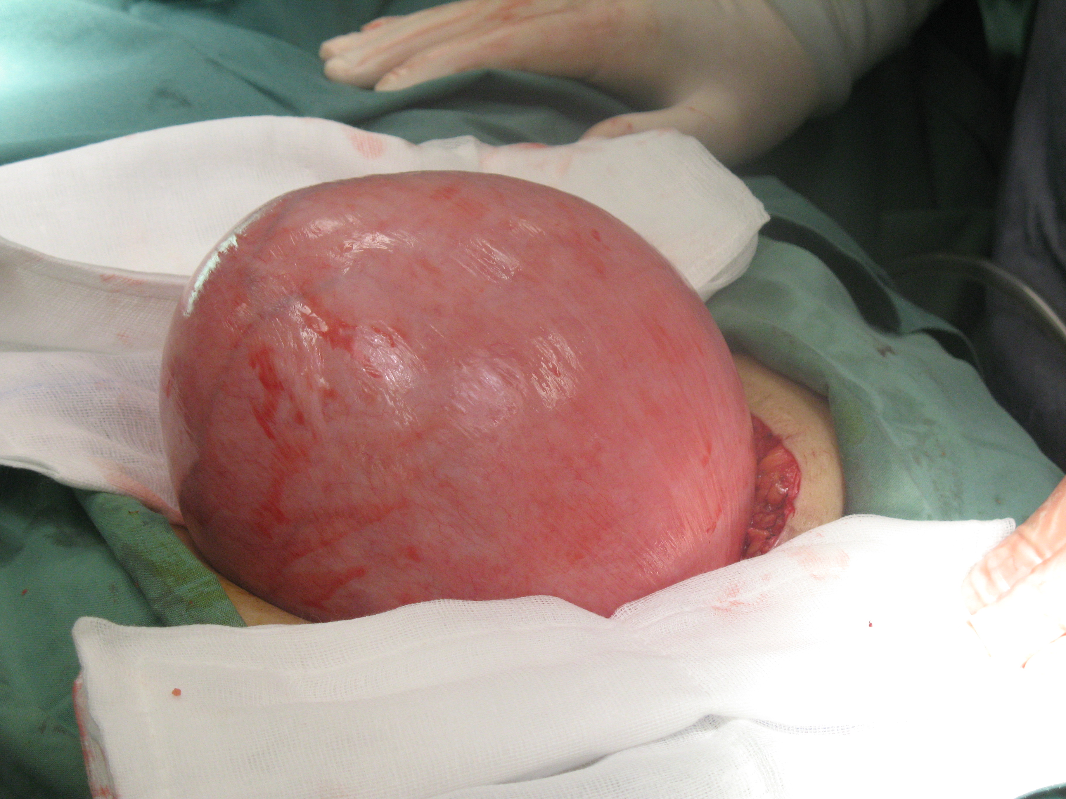fibroid uterus laparotomy serag youssif