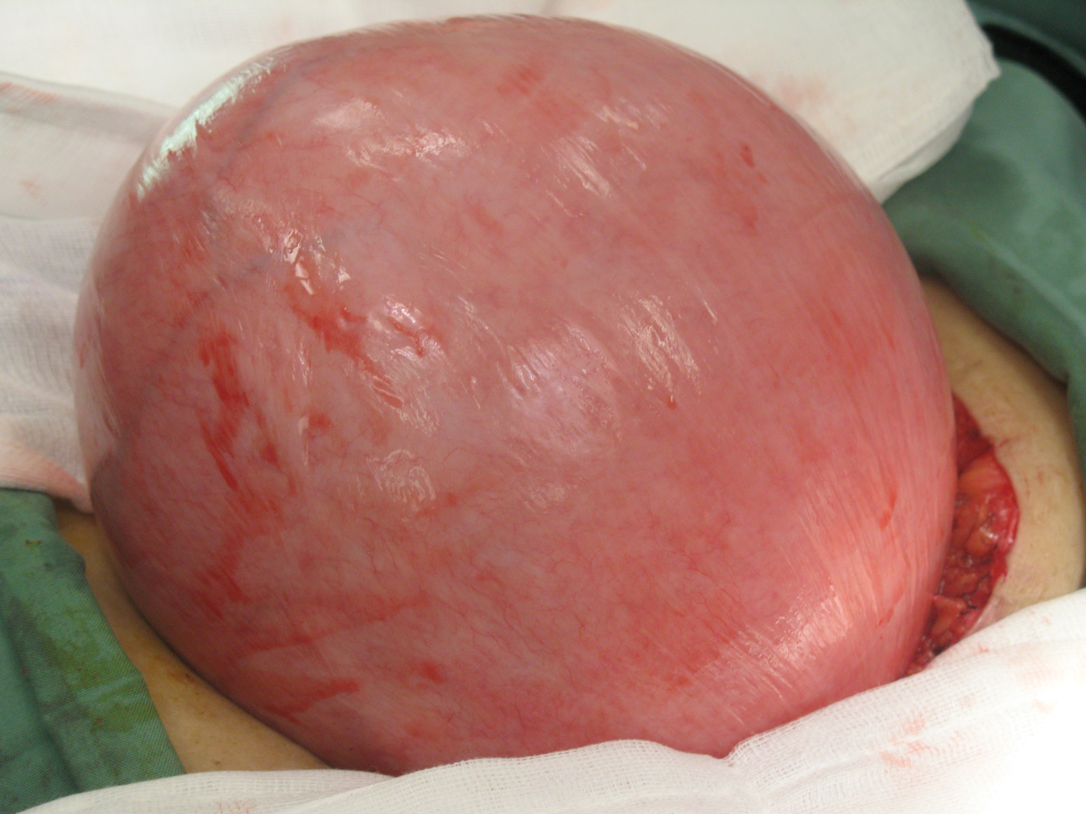 fibroid uterus large serag youssif