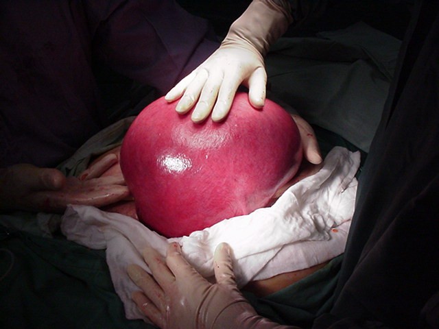 fibroid 6 kg hysterectomy