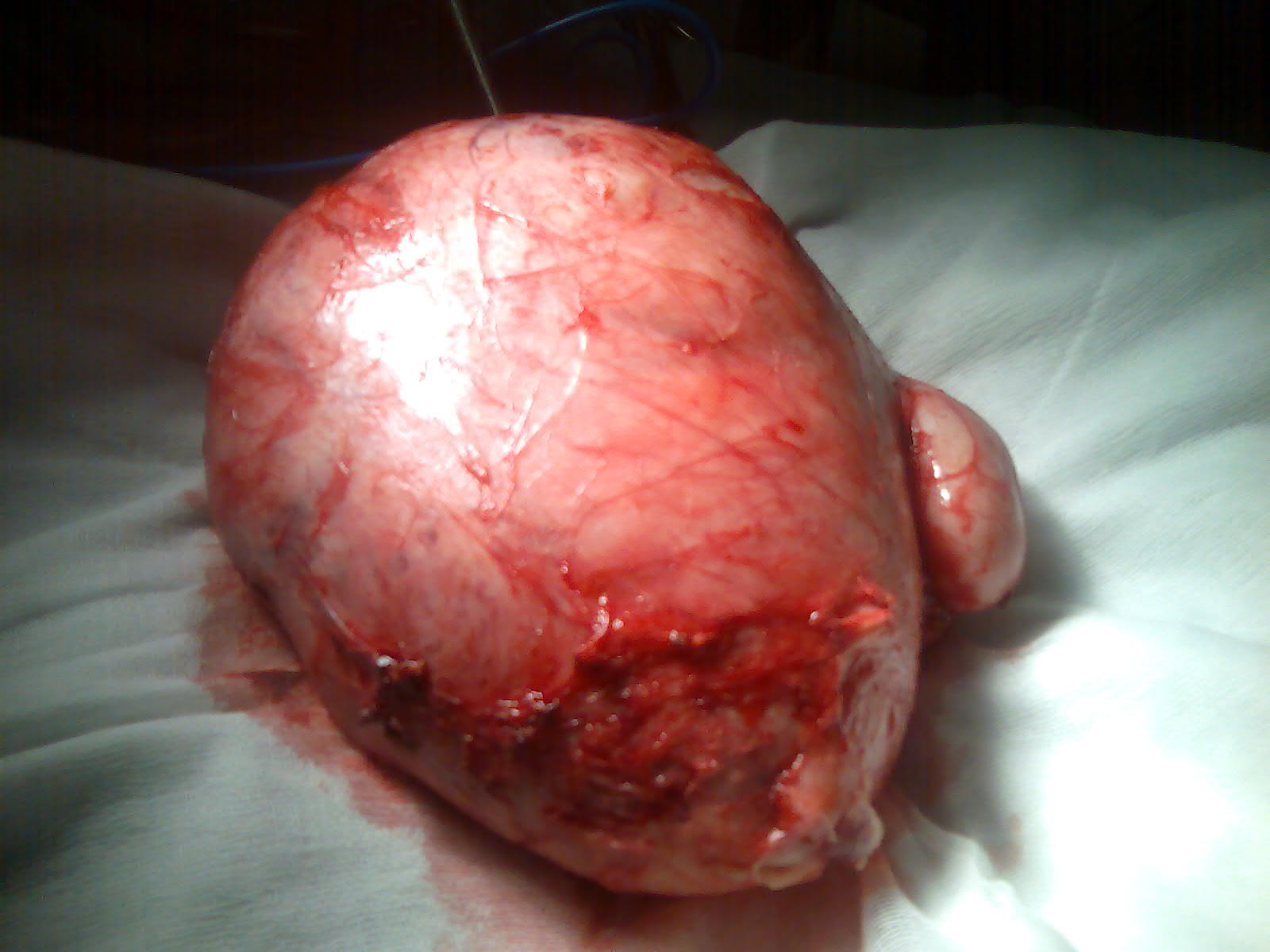 myomectomy cervical fibroid 30 cm youssif serag