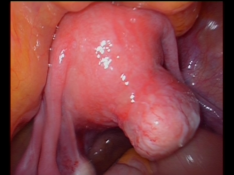 subseous fibroid posterior wall serag youssif