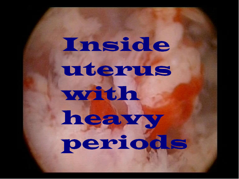endometrium before novasure